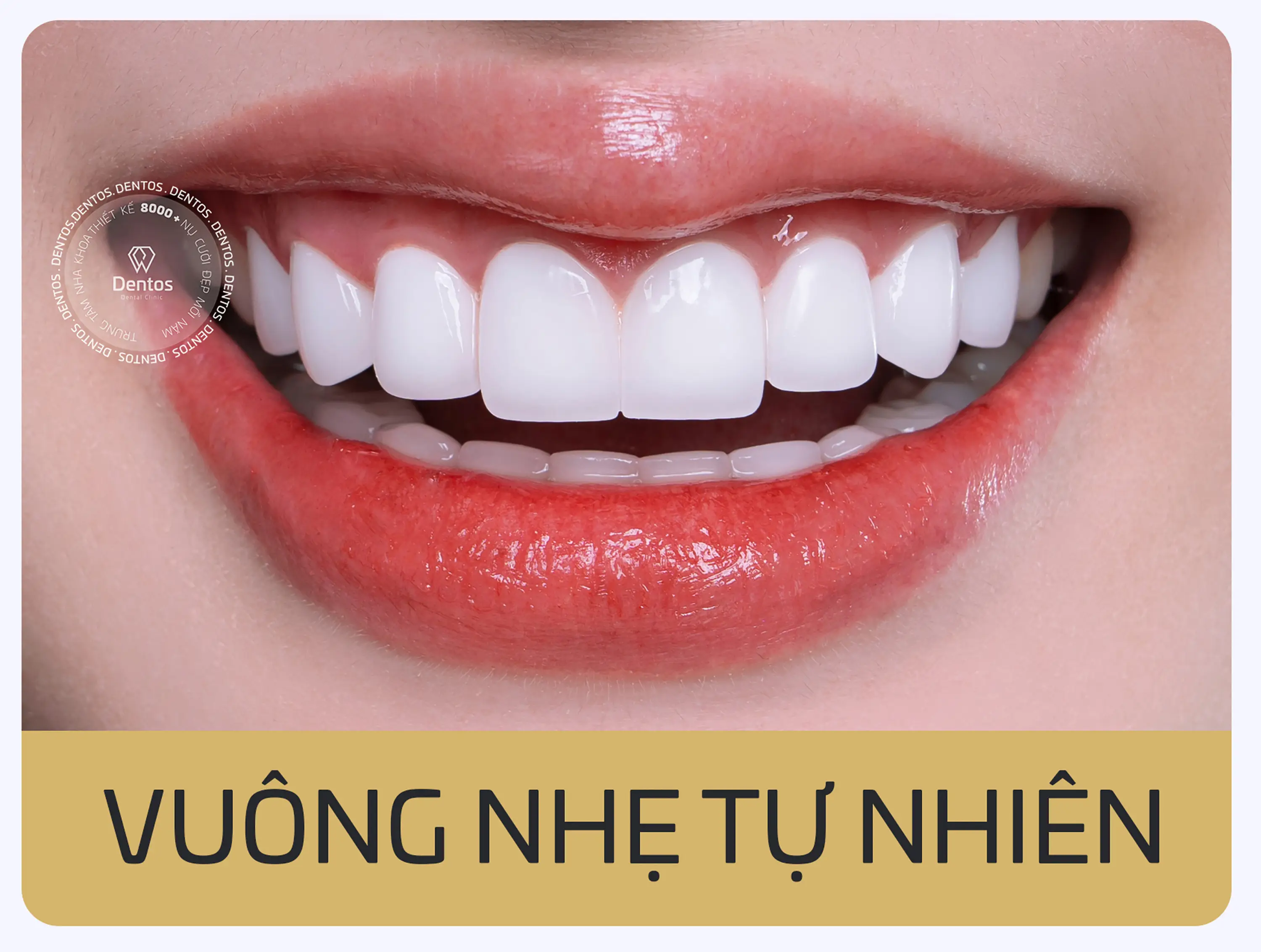 Dáng răng sứ vuông tự nhiên phù hợp cho nam giới